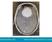 Neuronavarra Peritaciones Manuel Murie MENINGIOMA