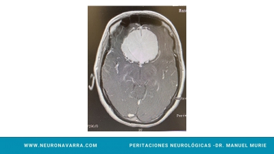 Neuronavarra Peritaciones Manuel Murie MENINGIOMA