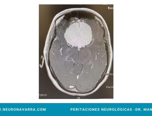 MENINGIOMA