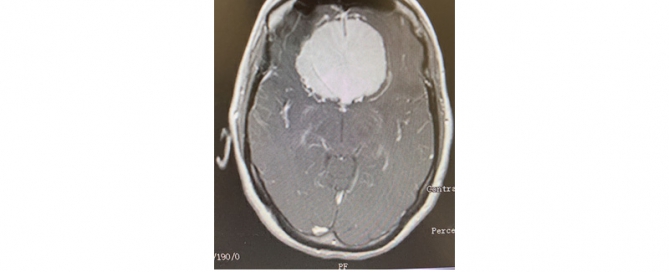 Neuronavarra Peritaciones Manuel Murie MENINGIOMA