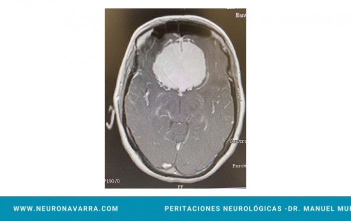 Neuronavarra Peritaciones Manuel Murie MENINGIOMA